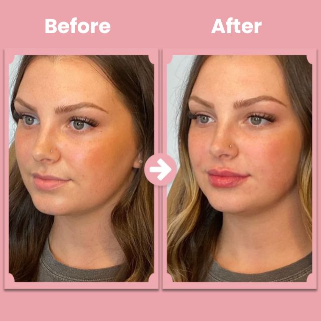 LushLips Roller Kit