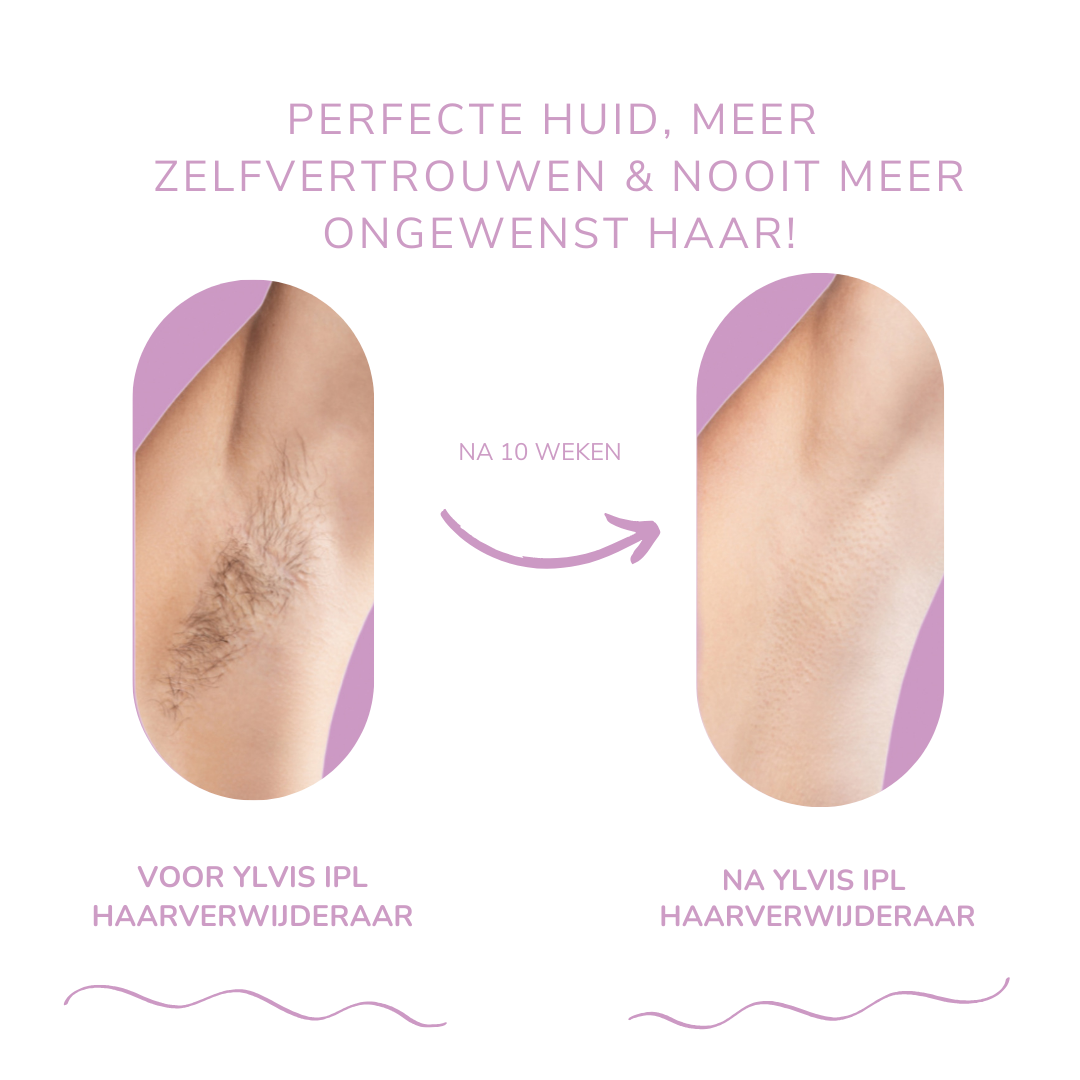 LysaSkin™ – Pijnloos glad, permanent zelfverzekerd