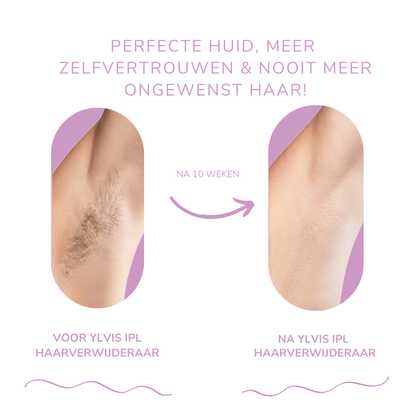 LysaSkin™ – Pijnloos glad, permanent zelfverzekerd