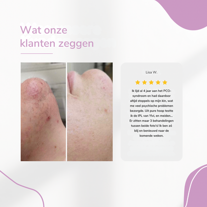 LysaSkin™ – Pijnloos glad, permanent zelfverzekerd
