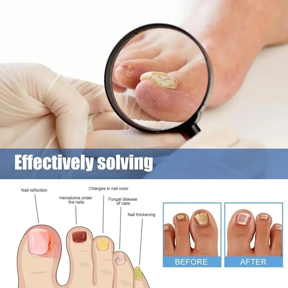 FungalPatch - Antibacterieel Schimmelwerend Patch En Nagelverzorging Pak