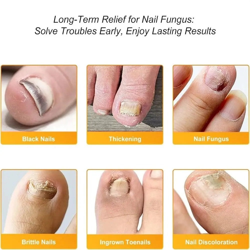 FungalPatch - Antibacterieel Schimmelwerend Patch En Nagelverzorging Pak