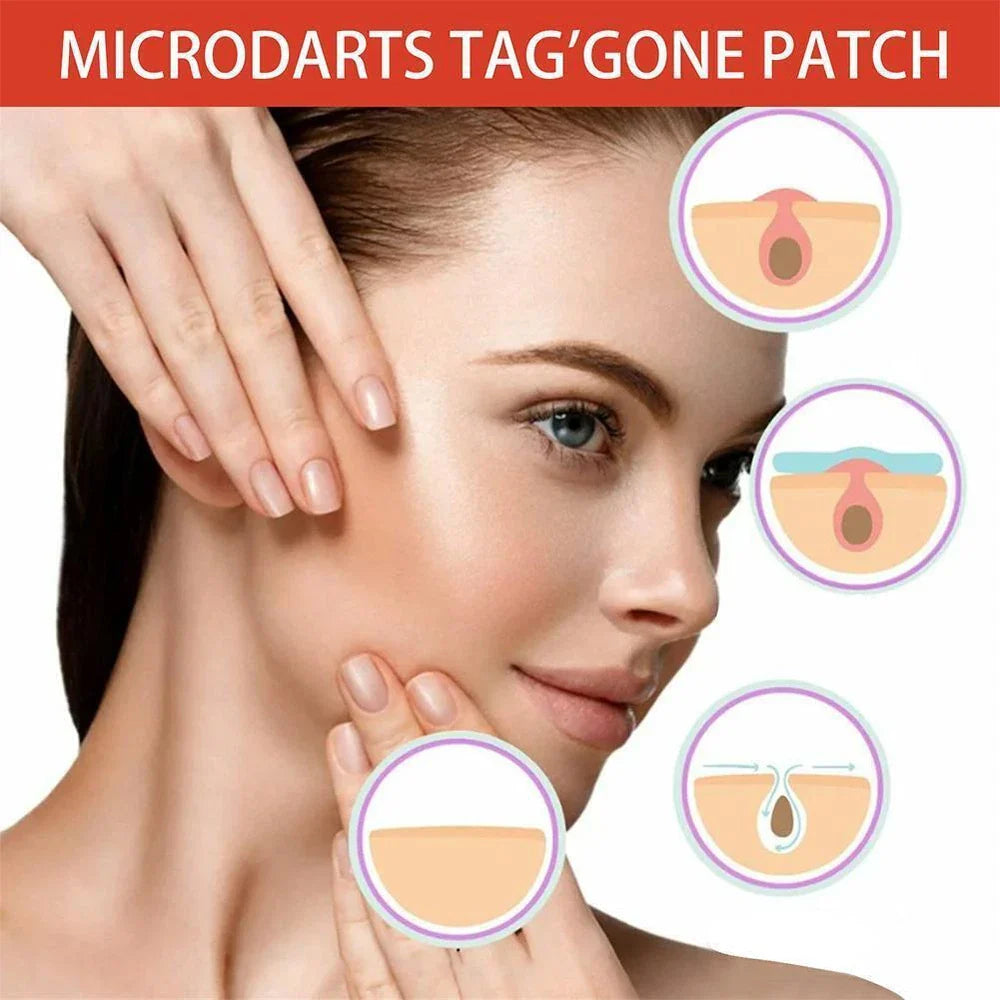 DermaDot™ MicroDarts – Pijnvrije verwijdering van huidaanhangsels