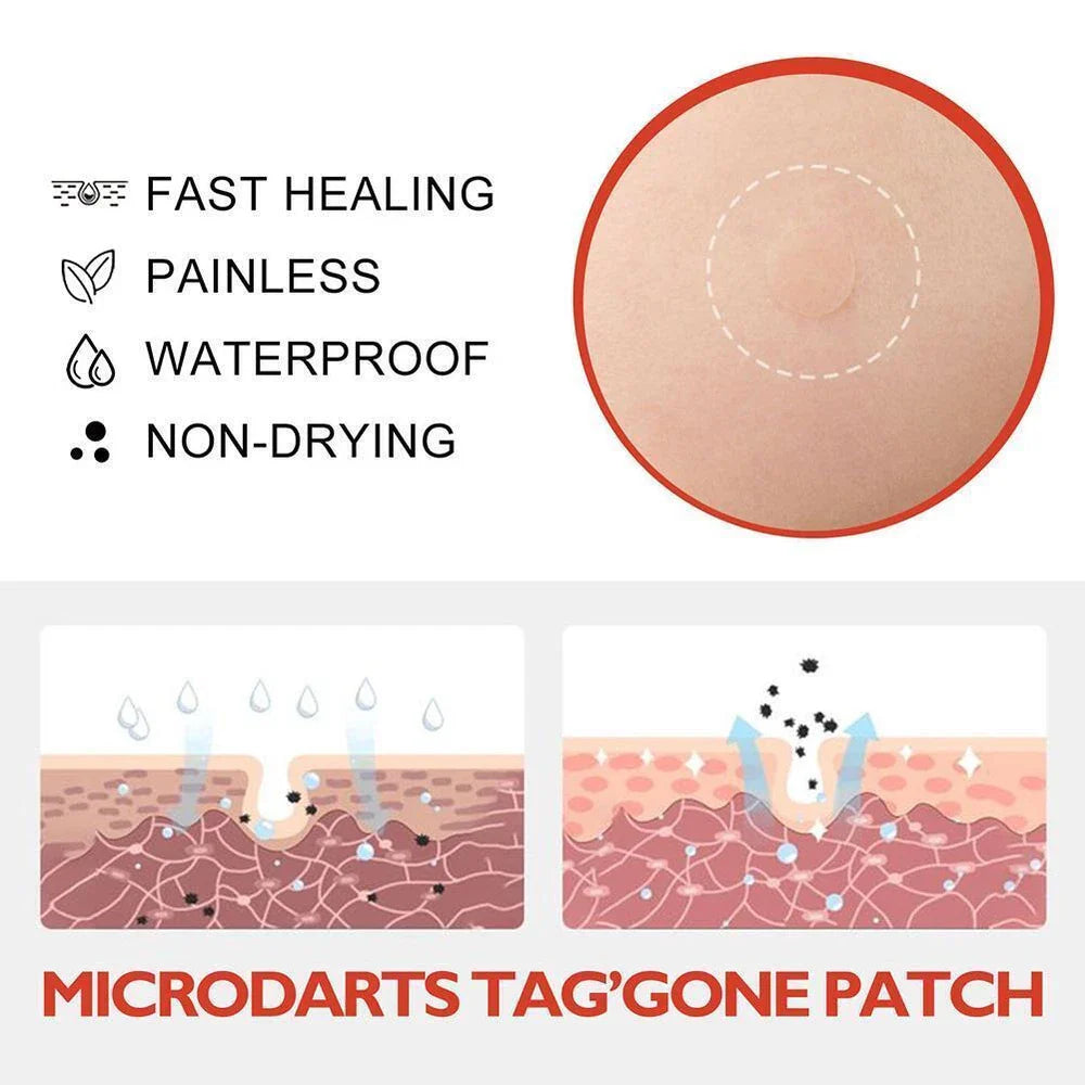 DermaDot™ MicroDarts – Pijnvrije verwijdering van huidaanhangsels