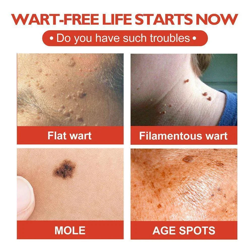 DermaDot™ MicroDarts – Pijnvrije verwijdering van huidaanhangsels