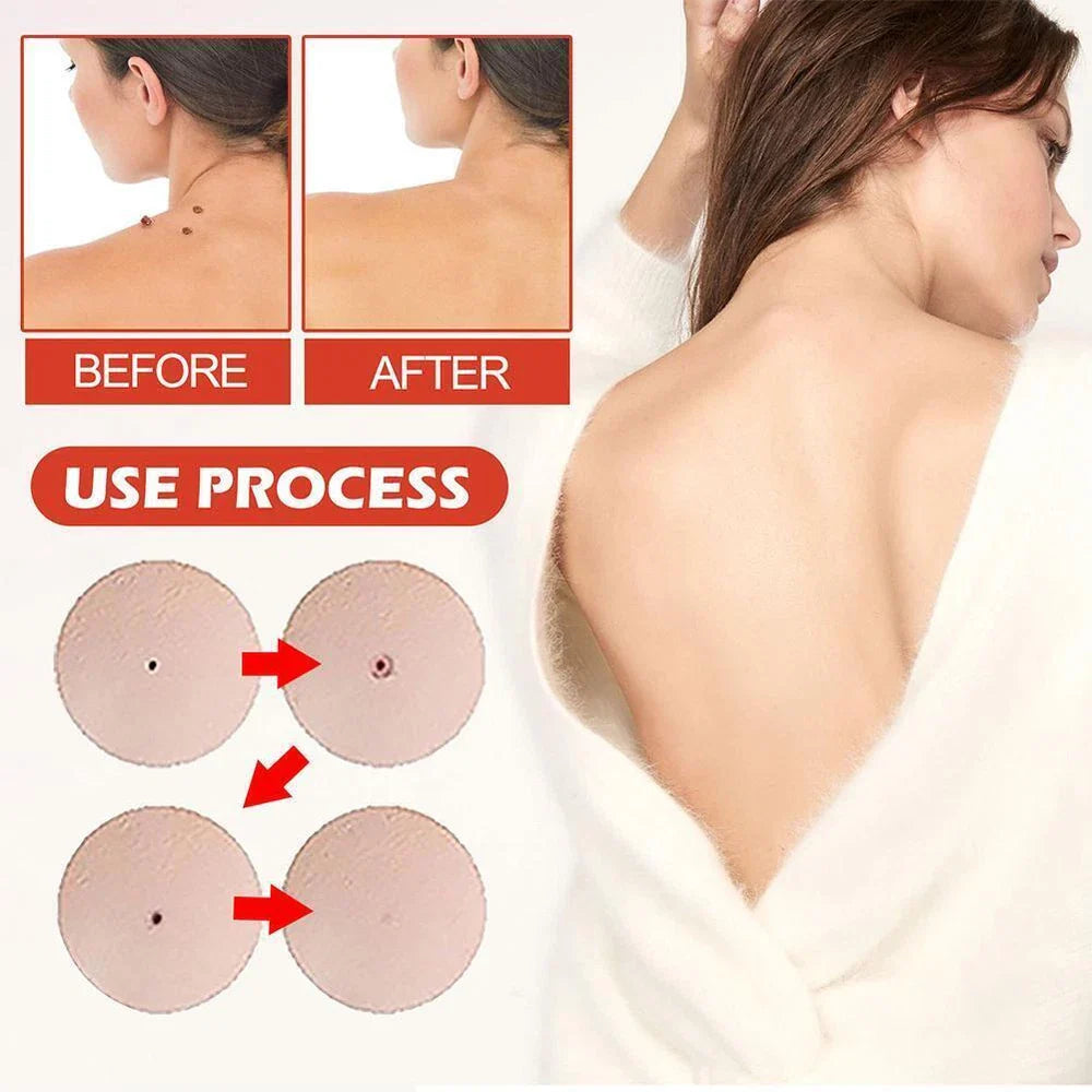 DermaDot™ MicroDarts – Pijnvrije verwijdering van huidaanhangsels