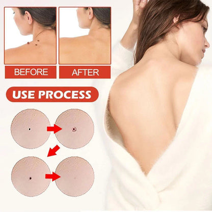 DermaDot™ MicroDarts – Pijnvrije verwijdering van huidaanhangsels